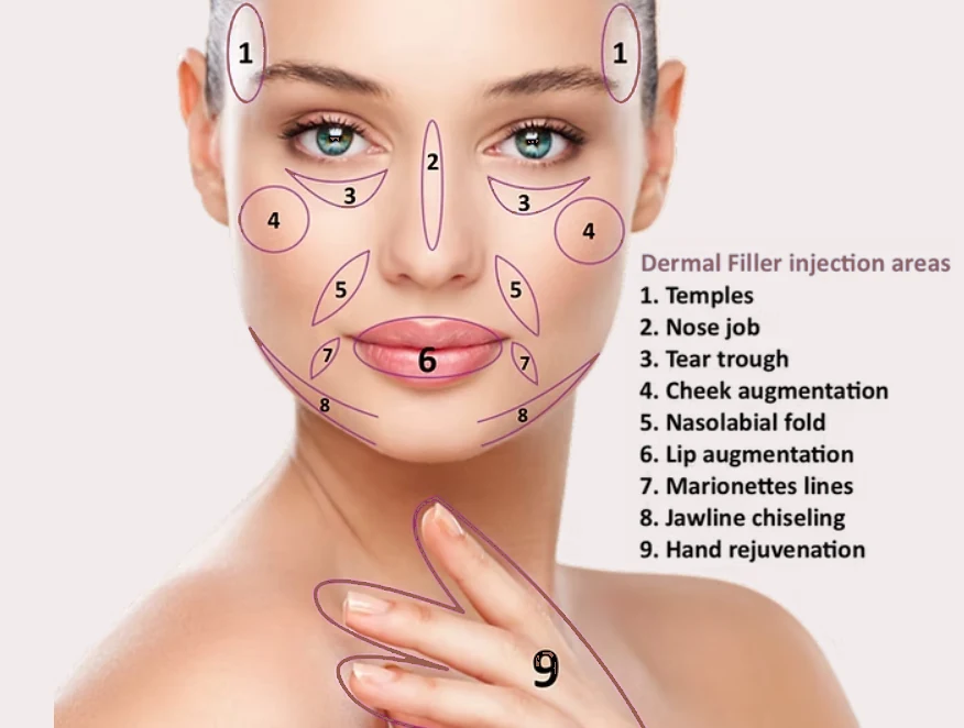 Diagram of dermal filler injection areas: temples, tear trough, cheeks, nasolabial folds, lips, marionette lines, jawline and hand rejuvenation