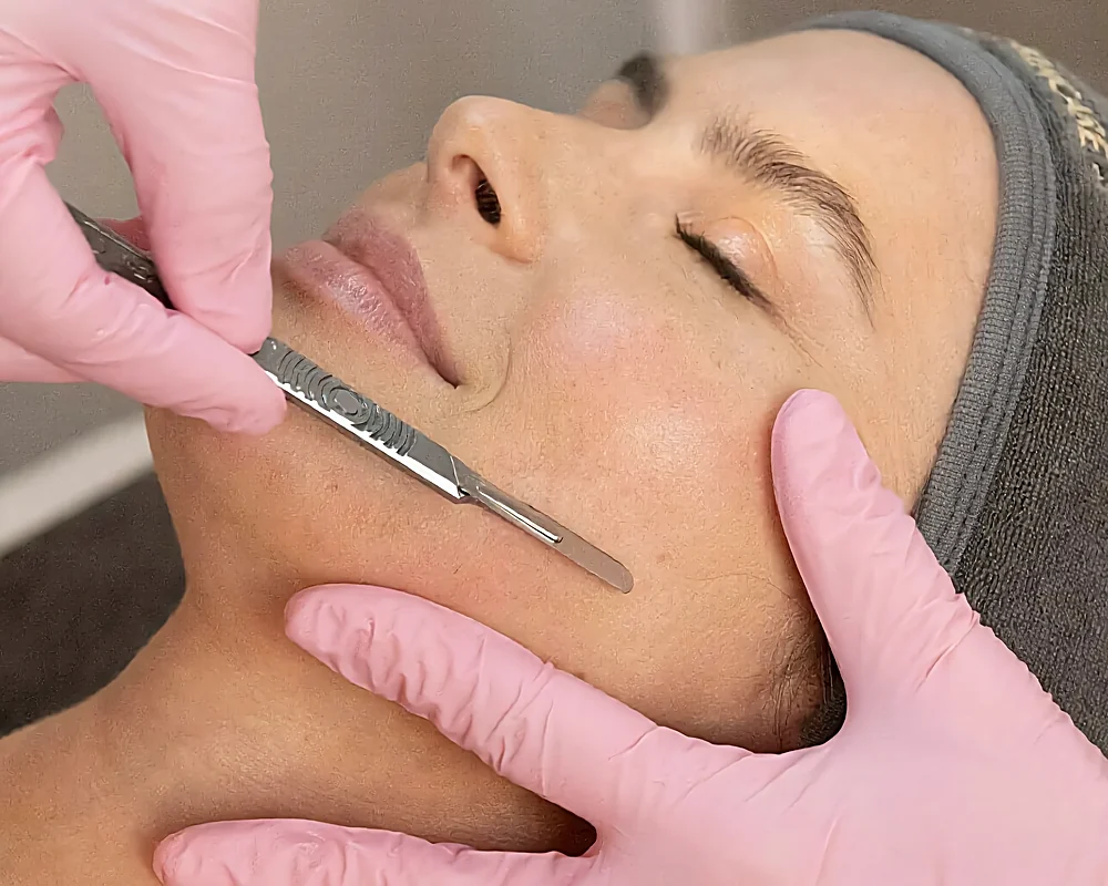 Dermaplaning facial treatment — a gloved professional using a blade on a client's cheek