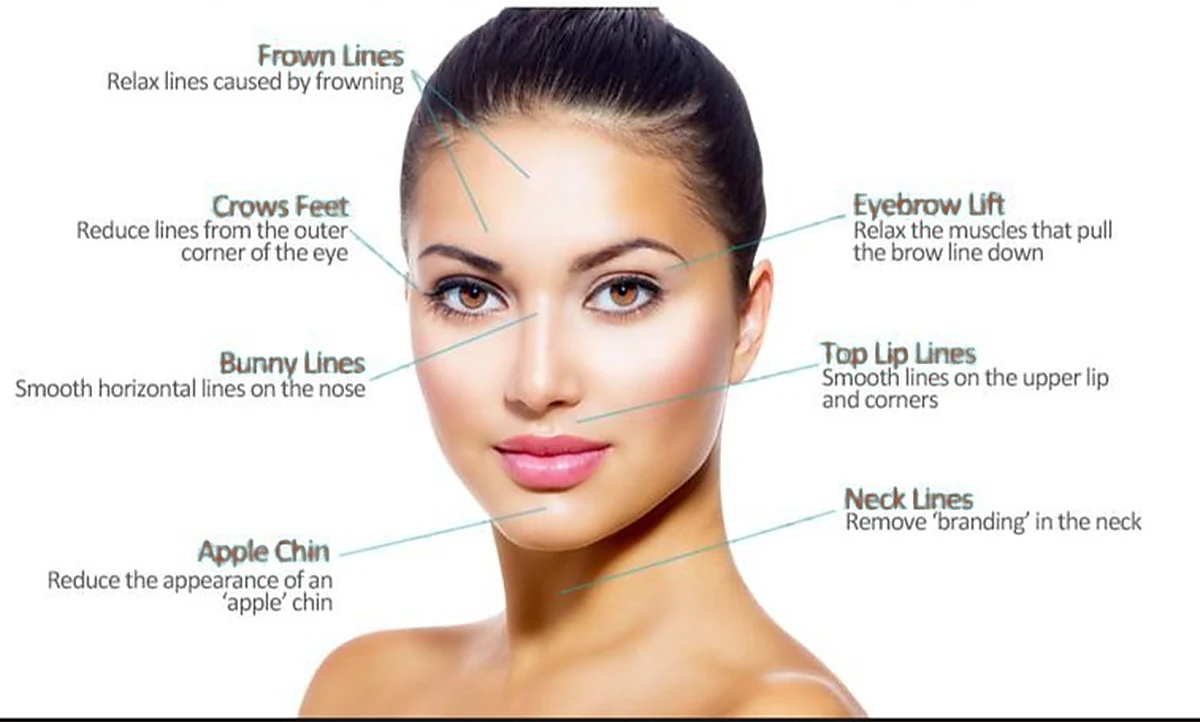 Diagram of the facial areas anti-wrinkle treatment can help: frown lines, crow's feet, bunny lines, eyebrow lift, top lip lines, apple chin and neck lines