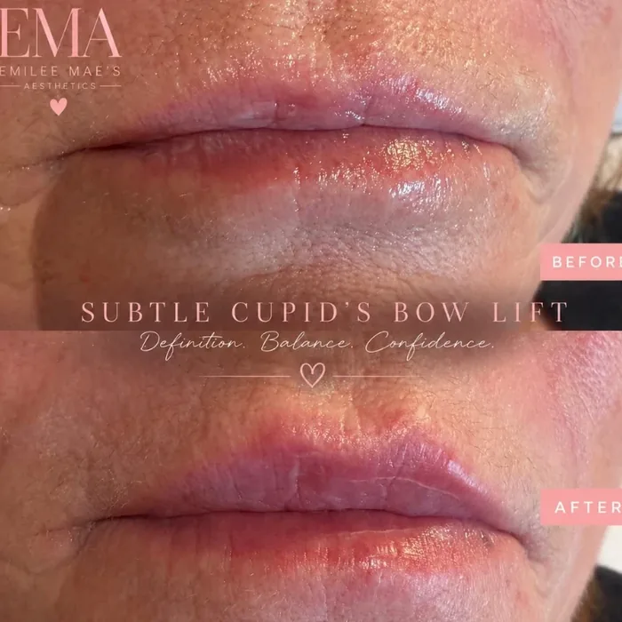 Subtle cupid's bow lip lift, before and after at EMA Aesthetics
