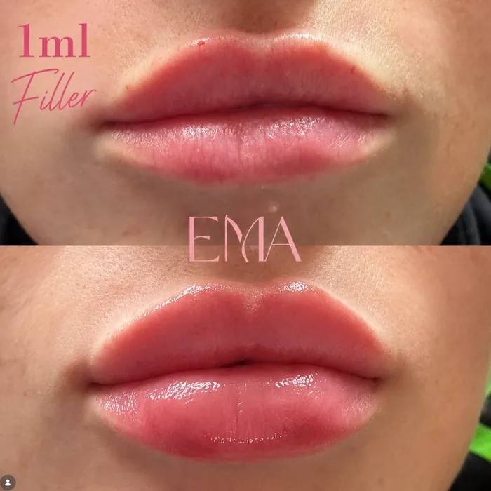 Natural 1ml lip filler result at EMA Aesthetics