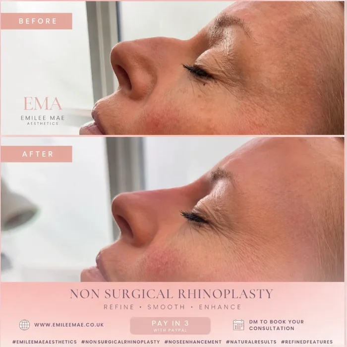 Non-surgical rhinoplasty, before and after at EMA Aesthetics