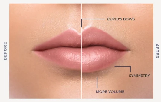 Before and after lip enhancement diagram showing cupid's bow definition, symmetry and added volume