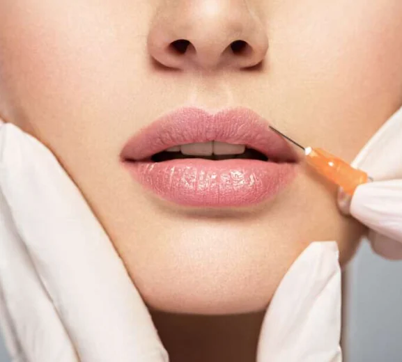 Close-up of a lip filler treatment being carried out with a fine needle