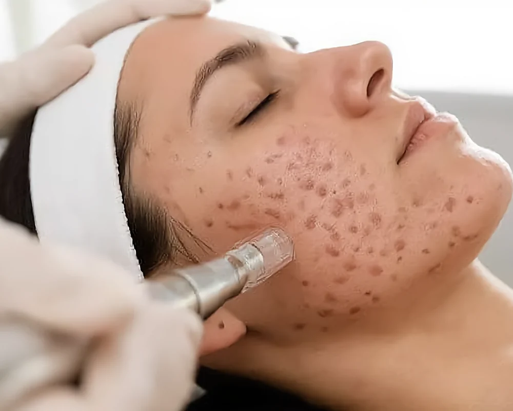 Microneedling treatment on a woman's face to improve skin texture and scarring
