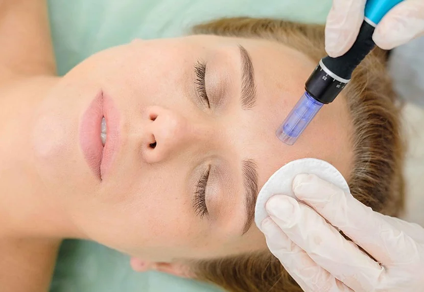 Woman receiving a microneedling treatment with a dermapen