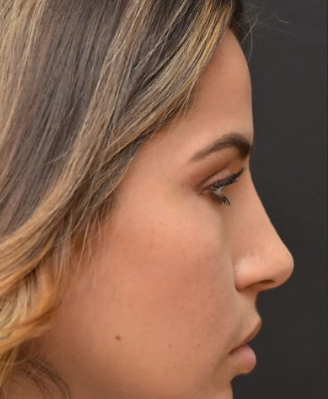 Side profile of a woman with a straight, refined nose