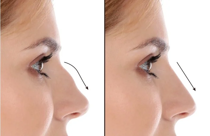 Nose profile before and after non-surgical rhinoplasty, showing a smoothed bridge