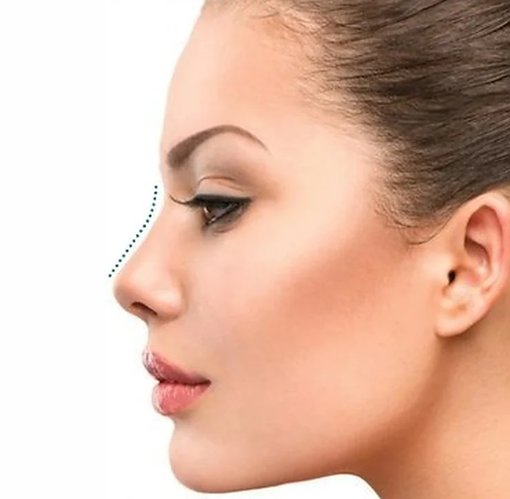 Profile of a woman showing the nose bridge line refined by non-surgical rhinoplasty