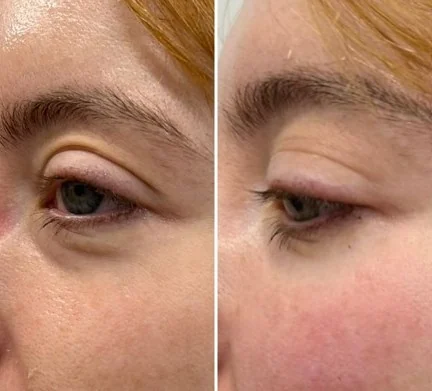 Before and after comparison of the under-eye area following polynucleotide treatment