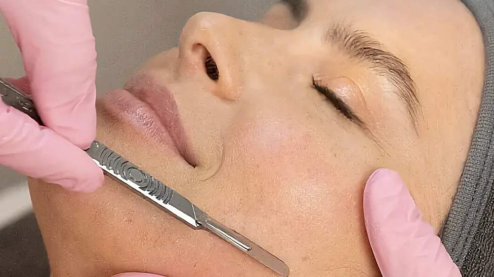 A dermaplaning treatment smoothing the skin with a blade