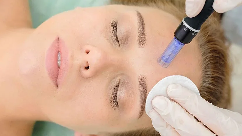 A woman receiving a microneedling treatment with a dermapen