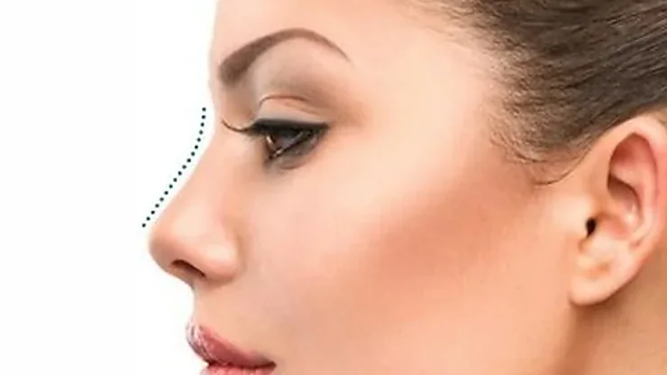 Side profile showing the nose bridge line refined without surgery