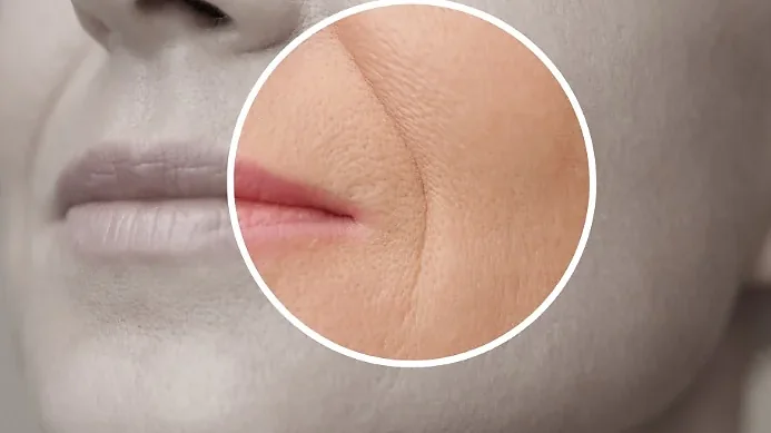Close-up highlighting a smile line running from nose to mouth