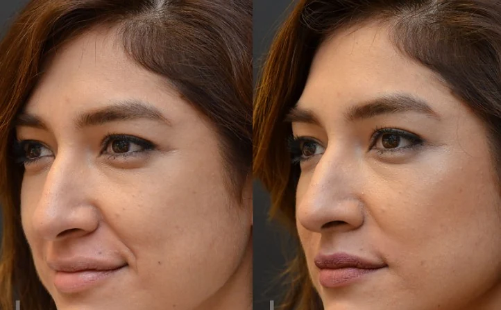Comparison of a lower face with smile lines softened
