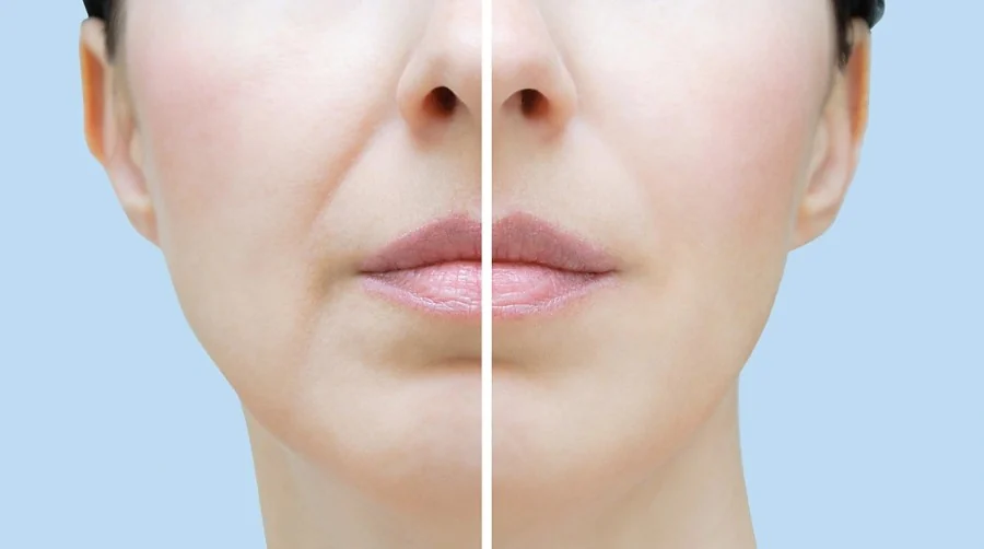 Lower face comparison showing smile lines softened